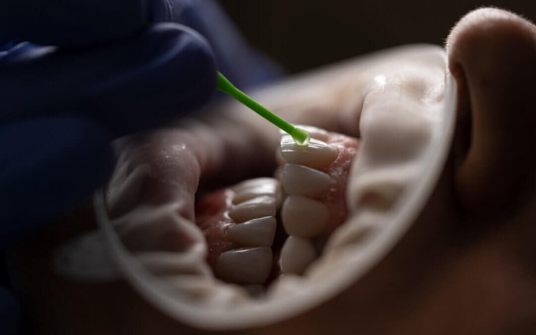 What to Expect From a Tooth Extraction With a Bone Graft
